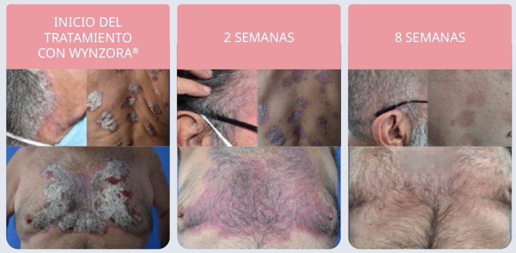 El efecto dominó de la psoriasis 4 Fig 4 Evolucion de la psoriasis en placas pac psiquiatrico Wynzora
