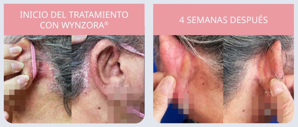 El efecto dominó de la psoriasis 5 Fig 5 Evolucion de la psoriasis en placas cuero cabelludo Wynzora