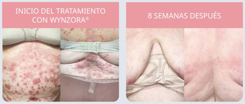 El efecto dominó de la psoriasis 7 Fig 7 Evolucion Wynzora 8 semanas