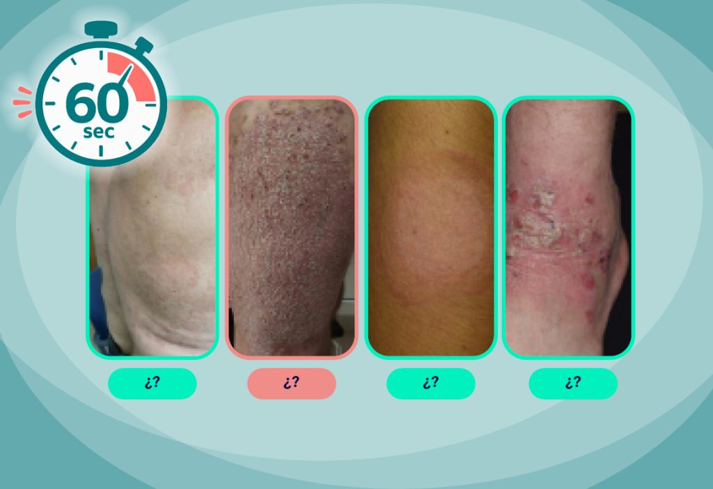 Diagnostico de psoriasis en 60 segundos