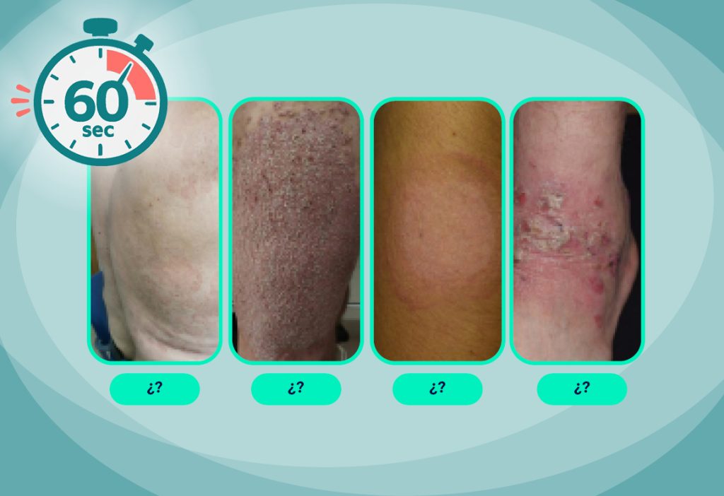 Otras Publicaciones 1 Diagnostico de psoriasis en 60 segundos