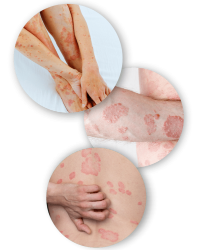 psoriasis-exuvia1 psoriasis-exuvia1