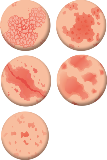 psoriasis-exuvia3 psoriasis-exuvia3